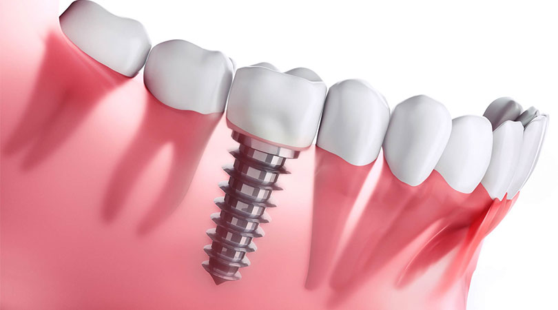 How long does a dental implant last?