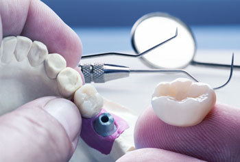 How long does a dental implant last?