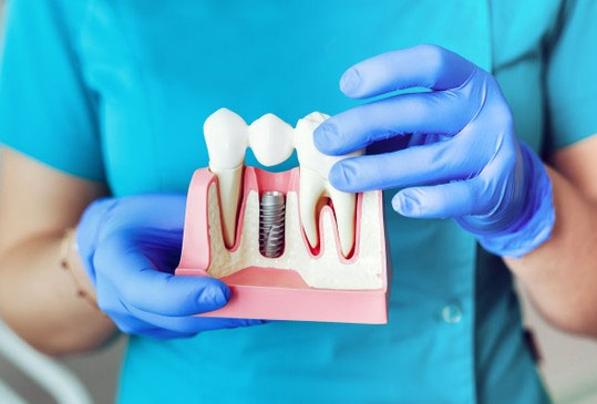 What are the benefits of dental implants?