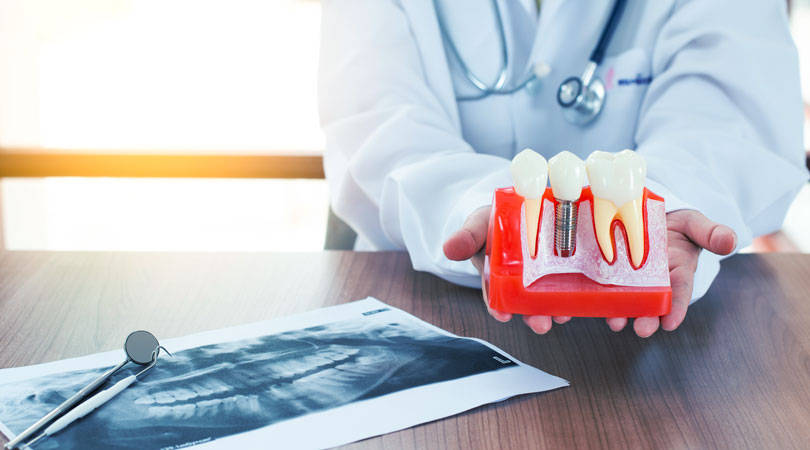 What are the benefits of dental implants?