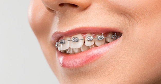 Dental Braces