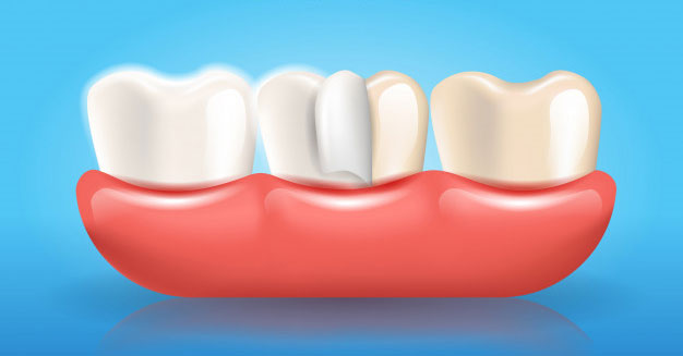 Dental Veneers
