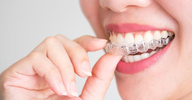 Dental Braces