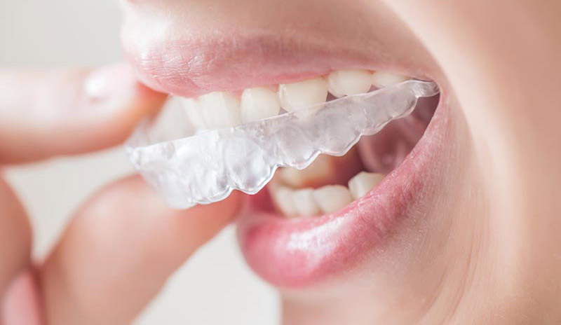 Dental Braces