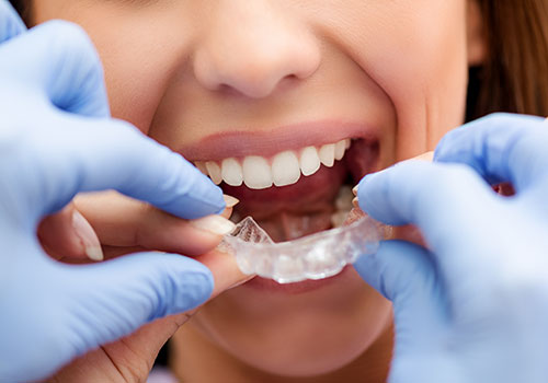 Dental Braces in kolkata