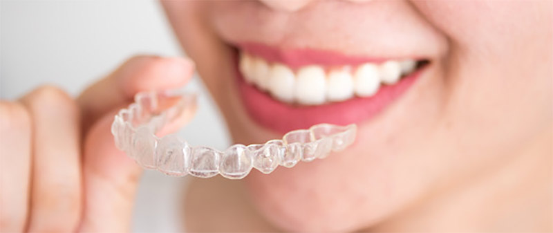 Dental Braces