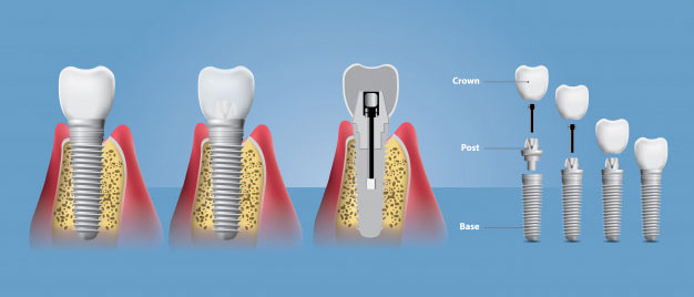 Dental Implants