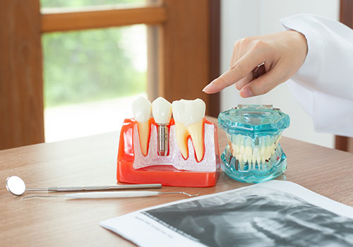best Dental Implants in kolkata
