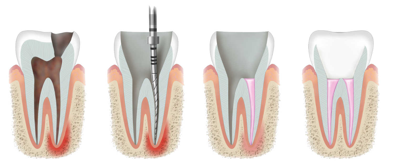 About Root Canal Treatment